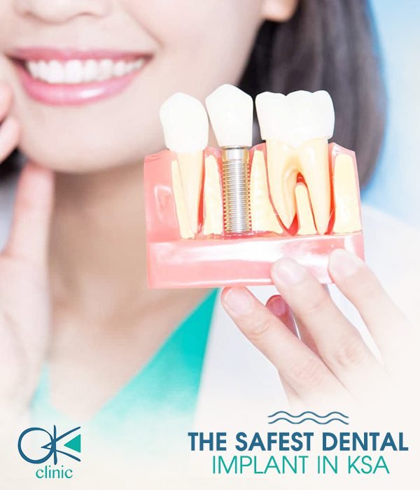 The-safest-dental-implant-in-KSA