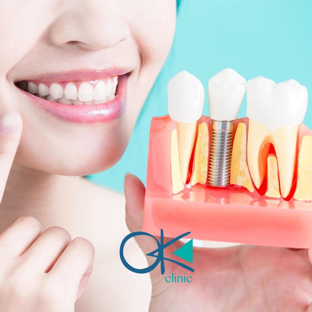 زراعة الأسنان واستبدال الأسنان المفقودة