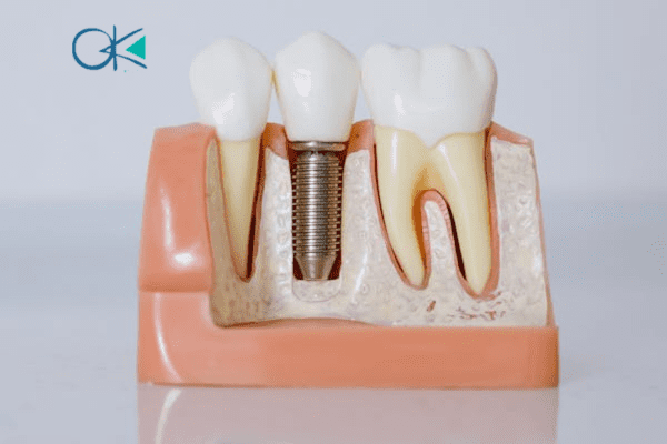 افضل طريقة علاج جذور الاسنان