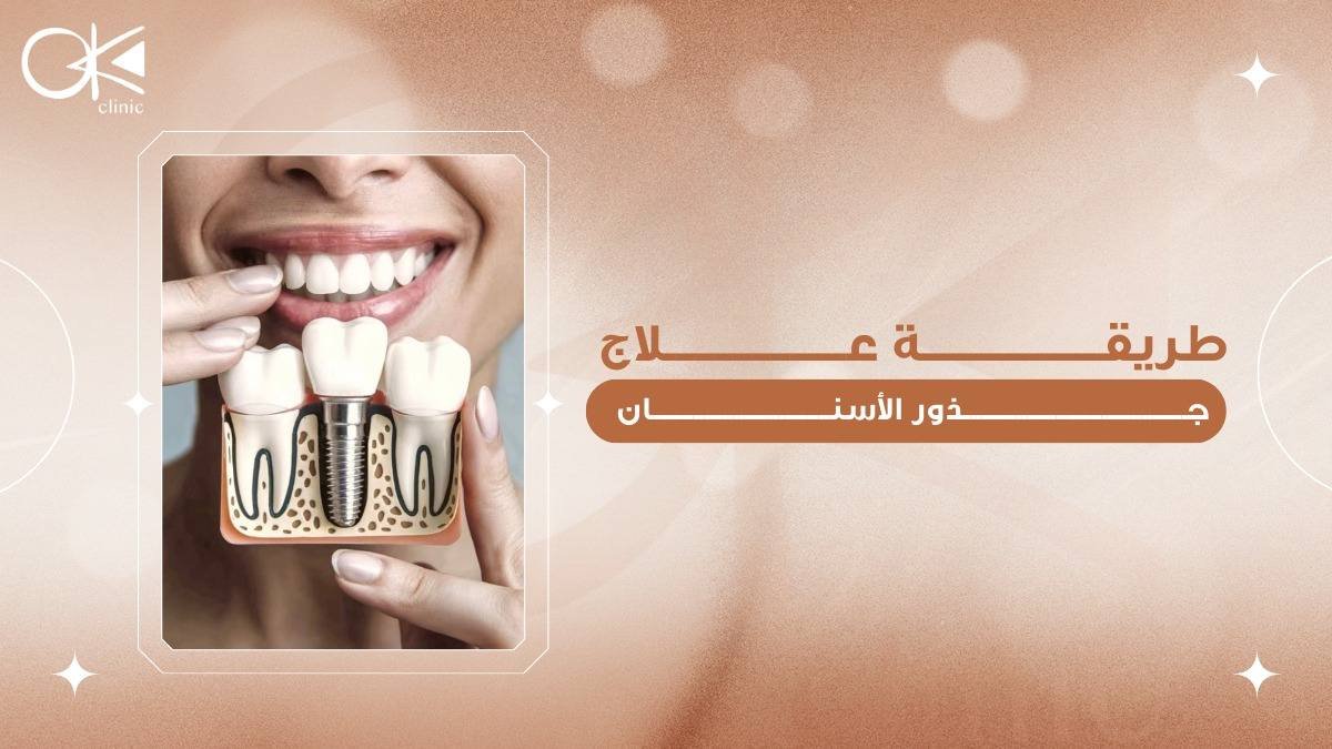 طريقة علاج جذور الاسنان