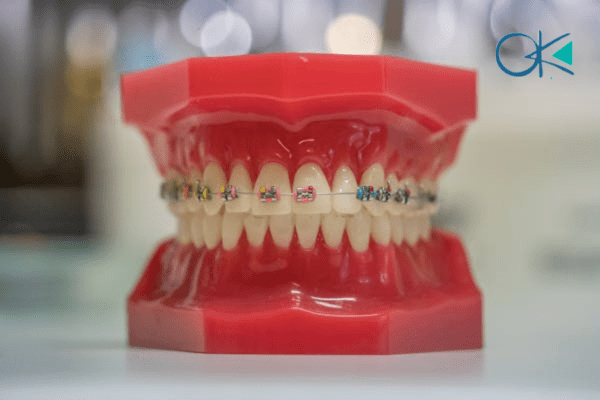 كيفية تنظيف الاسنان مع التقويم مع اوكي كلينيك