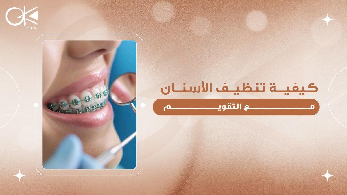 كيفية تنظيف الاسنان مع التقويم